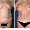 Orange County Cosmetic Surgery Clinique Before & After Body Lift 4 - Front