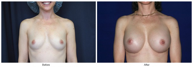 Orange County Cosmetic Surgery Clinique Before & After Breast Augmentation 1 - Front