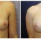 Orange County Cosmetic Surgery Clinique Before & After Breast Augmentation 4 - Front