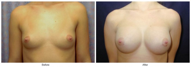 Orange County Cosmetic Surgery Clinique Before & After Breast Augmentation 4 - Front