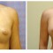 Orange County Cosmetic Surgery Clinique Before & After Breast Augmentation 5 - Front