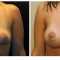 Orange County Cosmetic Surgery Clinique Before & After Breast Augmentation 6 - Front