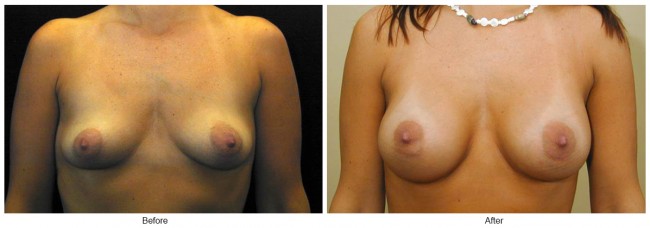 Orange County Cosmetic Surgery Clinique Before & After Breast Augmentation 6 - Front