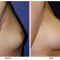 Orange County Cosmetic Surgery Clinique Before & After Breast Augmentation 7 - Right