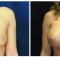 Orange County Cosmetic Surgery Clinique Before & After Breast Augmentation 8 - Front