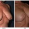 Orange County Cosmetic Surgery Clinique Before & After Breast Lift 10 - Right Quarter