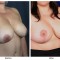 Orange County Cosmetic Surgery Clinique Before & After Breast Lift 11 - Right Quarter