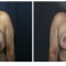 Orange County Cosmetic Surgery Clinique Before & After Breast Lift 12 - Front