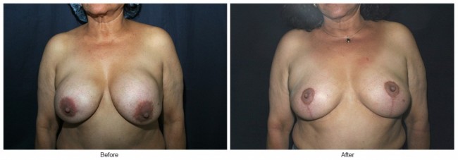 Orange County Cosmetic Surgery Clinique Before & After Breast Lift 12 - Front