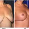 Orange County Cosmetic Surgery Clinique Before & After Breast Lift 13 - Right Quarter