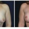 Orange County Cosmetic Surgery Clinique Before & After Breast Lift 14 - Front