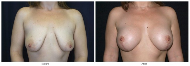 Orange County Cosmetic Surgery Clinique Before & After Breast Lift 14 - Front