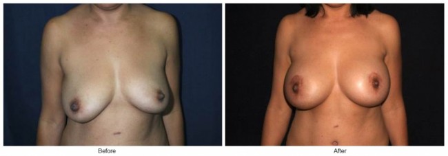 Orange County Cosmetic Surgery Clinique Before & After Breast Lift 4 - Front