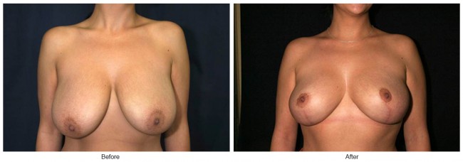 Orange County Cosmetic Surgery Clinique Before & After Breast Reduction 1 - Front