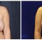 Orange County Cosmetic Surgery Clinique Before & After Breast Reduction 3 - Front