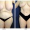 Orange County Cosmetic Surgery Clinique Before & After Breast Reduction 4 - Front