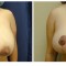 Orange County Cosmetic Surgery Clinique Before & After Breast Reduction 5 - Front