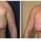 Orange County Cosmetic Surgery Clinique Before & After Breast Reduction 6 - Front