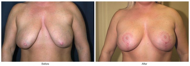 Orange County Cosmetic Surgery Clinique Before & After Breast Reduction 6 - Front