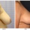 Orange County Cosmetic Surgery Clinique Before & After Breast Reduction 7 - Right