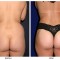 Orange County Cosmetic Surgery Clinique Before & After Buttock Augmentation 3 - Front