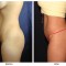 Orange County Cosmetic Surgery Clinique Before & After Buttock Augmentation 4 - Right