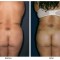 Orange County Cosmetic Surgery Clinique Before & After Buttock Augmentation 5 - Front