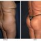 Orange County Cosmetic Surgery Clinique Before & After Buttock Augmentation 7 - Left Quarter