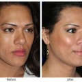 Orange County Cosmetic Surgery Clinique Before & After Cheek Implant 1 - Right Quarter