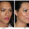 Orange County Cosmetic Surgery Clinique Before & After Cheek Implant 1 - Right Quarter