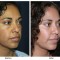 Orange County Cosmetic Surgery Clinique Before & After Cheek Implant 2