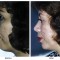 Orange County Cosmetic Surgery Clinique Before & After Chin Implant 1