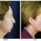 Orange County Cosmetic Surgery Clinique Before & After Chin Implant 2