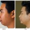 Orange County Cosmetic Surgery Clinique Before & After Chin Implant 3