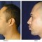 Orange County Cosmetic Surgery Clinique Before & After Chin Implant 4