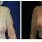 Orange County Cosmetic Surgery Clinique Before & After Crescent Lift 1 - Front