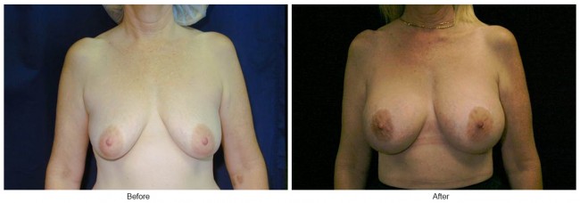 Orange County Cosmetic Surgery Clinique Before & After Crescent Lift 1 - Front