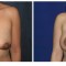 Orange County Cosmetic Surgery Clinique Before & After Crescent Lift 2 - Front