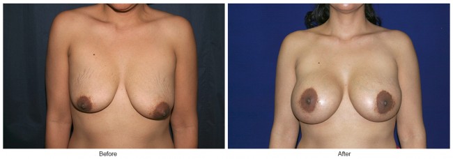 Orange County Cosmetic Surgery Clinique Before & After Crescent Lift 2 - Front