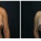 Orange County Cosmetic Surgery Clinique Before & After Crescent Lift 3 - Front