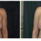 Orange County Cosmetic Surgery Clinique Before & After Crescent Lift 4 - Front