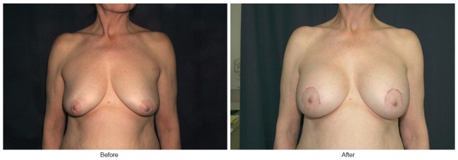 Orange County Cosmetic Surgery Clinique Before & After Crescent Lift 4 - Front