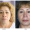 Orange County Cosmetic Surgery Clinique Before & After Eyelid Surgery 1