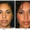 Orange County Cosmetic Surgery Clinique Before & After Eyelid Surgery 2