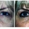 Orange County Cosmetic Surgery Clinique Before & After Eyelid Surgery 3