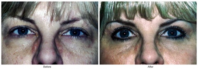 Orange County Cosmetic Surgery Clinique Before & After Eyelid Surgery 3