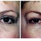 Orange County Cosmetic Surgery Clinique Before & After Eyelid Surgery 4