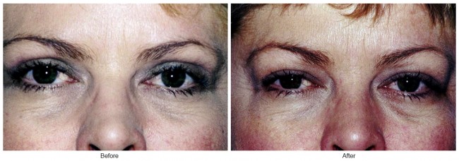 Orange County Cosmetic Surgery Clinique Before & After Eyelid Surgery 4