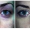 Orange County Cosmetic Surgery Clinique Before & After Eyelid Surgery 5