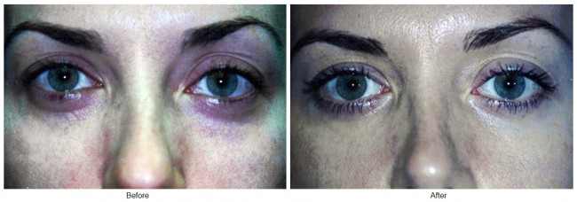 Orange County Cosmetic Surgery Clinique Before & After Eyelid Surgery 5